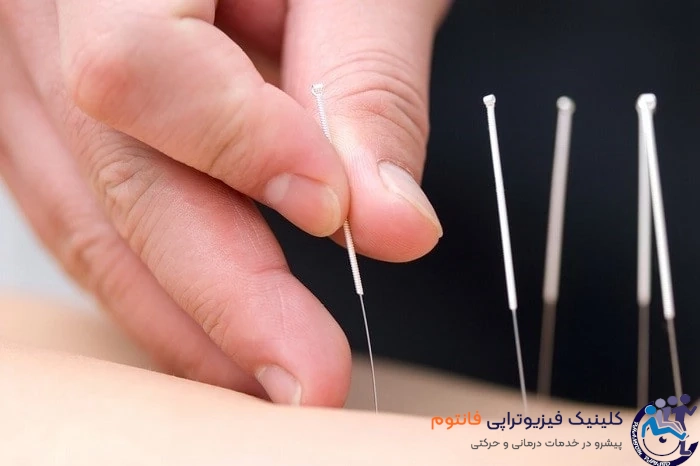 طب سوزنی - فیزیوتراپی پونک زنجان