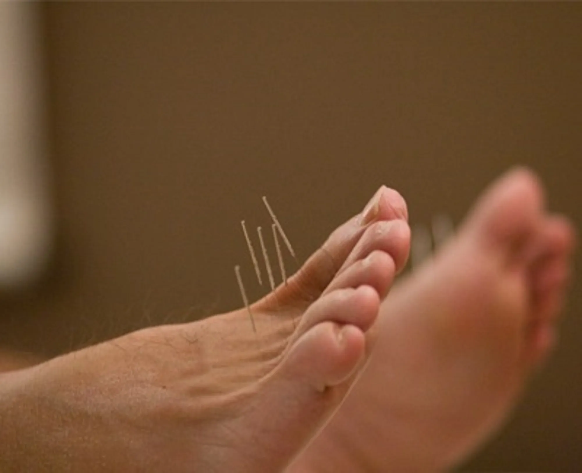 طب سوزنی برای درد پا و پاشنه - فیزیوتراپی پونک زنجان