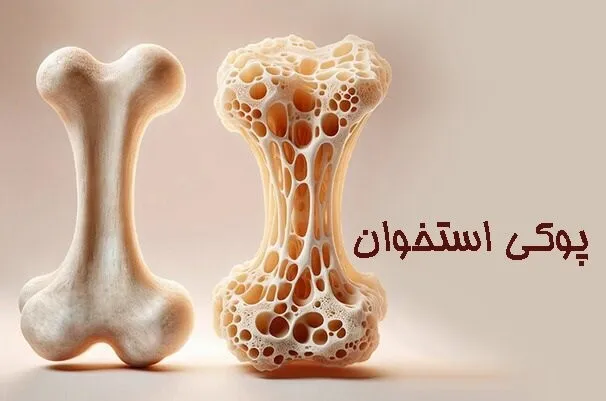 پوکی استخوان: دزد خاموش استخوان‌های شما! فیزیوتراپی پونک زنجان