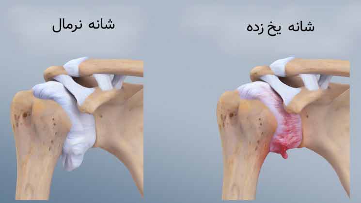 شانه یخ زده ؛ دلایل، علائم و جدیدترین روشهای درمان