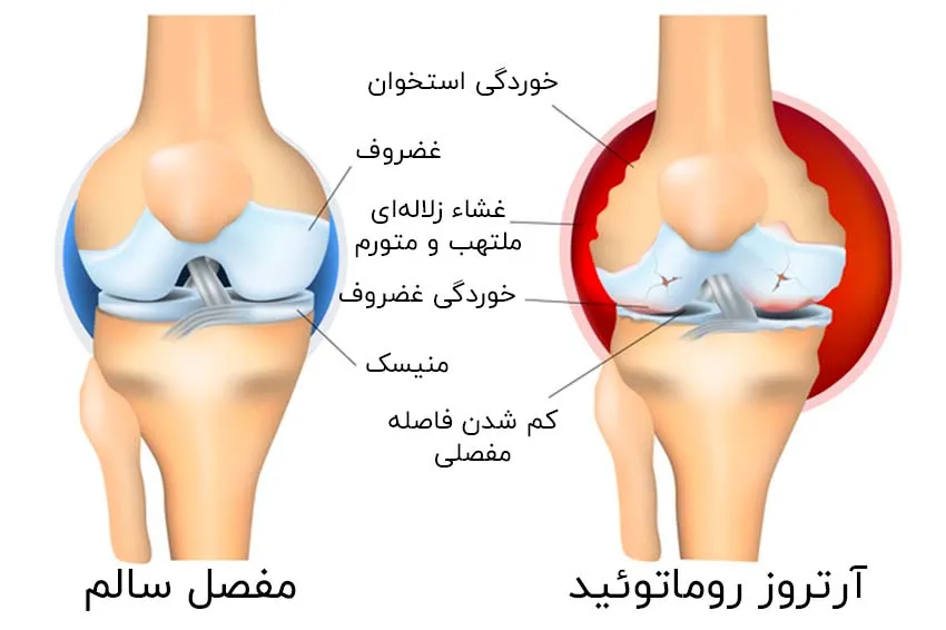 علائم و نشانه‌های آرتروز بر اساس محل ایجاد