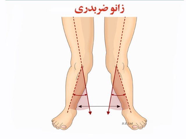 منوال تراپی برای زانو ضربدری