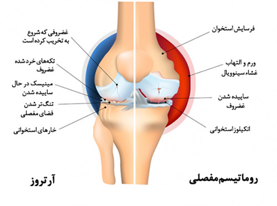 تفاوت روماتیسم زانو با آرتروز زانو