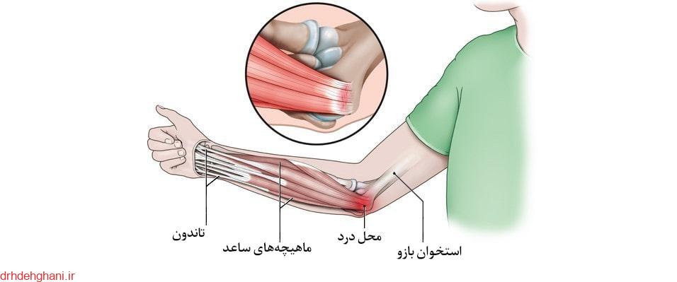 روش های درمان آرنج گلف بازان در فیزیوتراپی پونک زنجان