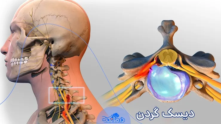 درمان قطعی دیسک گردن با روشهای نوین