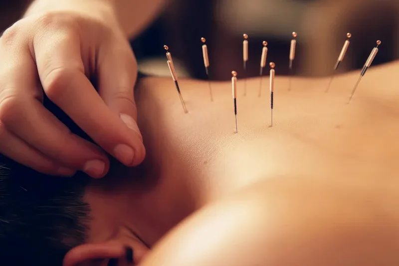 انجام طب سوزنی برای دیسک گردن