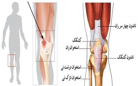 لیزر پرتوان برای تاندونیت عضله چهار سر