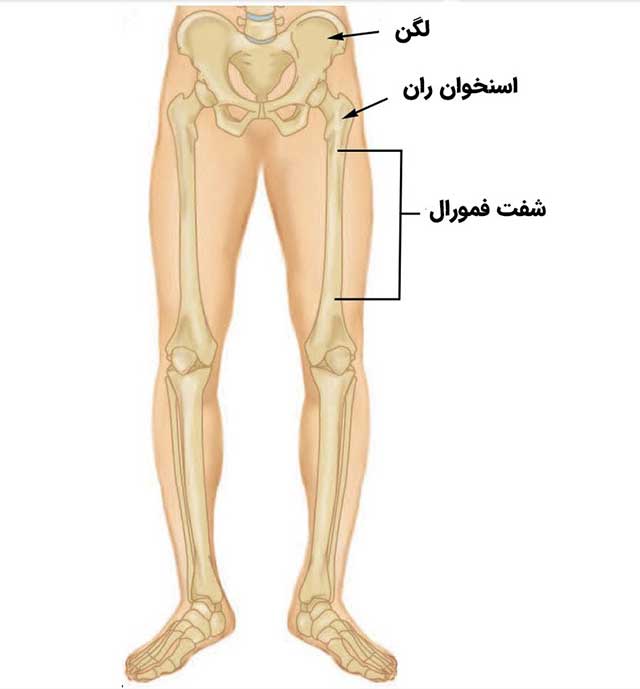روش های درمان شکستگی فمور در فیزیوتراپی پونک زنجان