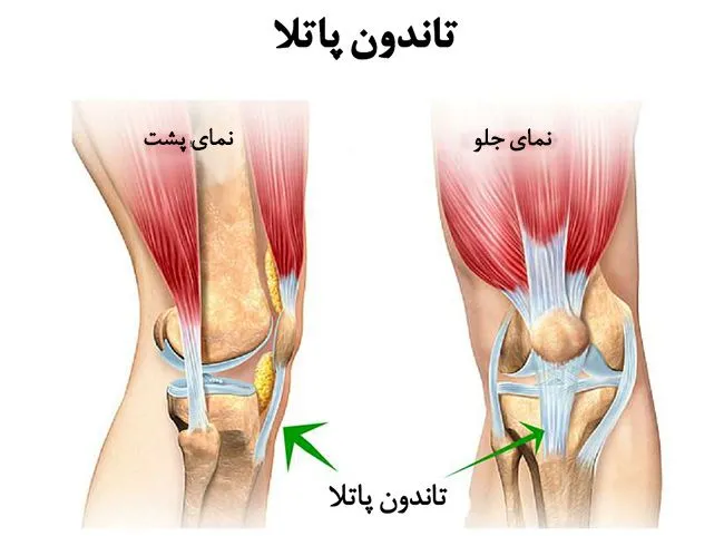 روش های درمان التهاب رباط پتلار در فیزیوتراپی پونک زنجان