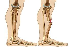 طب سوزنی برای شکستگی تیبیا