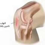 التهاب رباط پتلار چیست و چه علائمی دارد؟