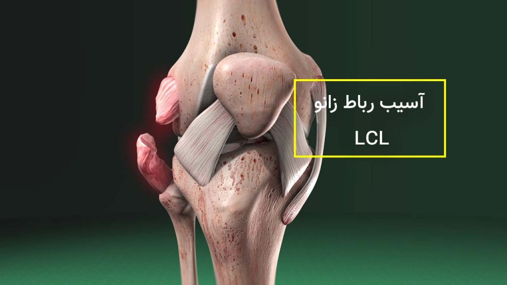 کشیدگی یا پارگی رباط خارجی زانوLCL چیست و چه علائمی دارد؟