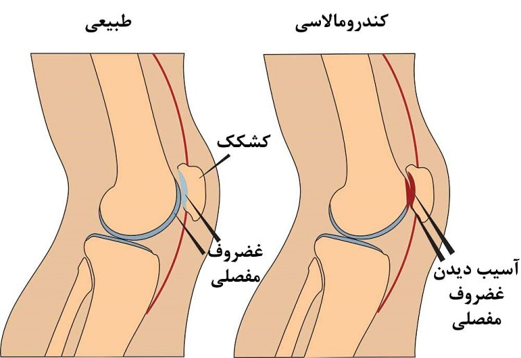 روش های درمان نرمی غضروف زانو در فیزیوتراپی پونک زنجان