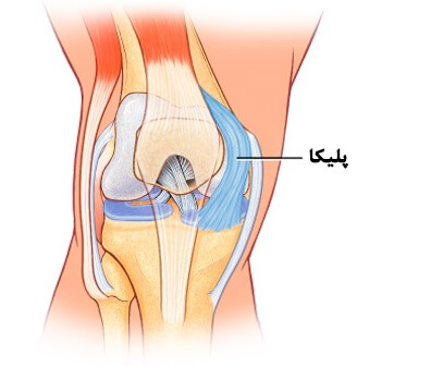 پلیکای مدیال زانو: از تشخیص تا مدیریت درمانی
