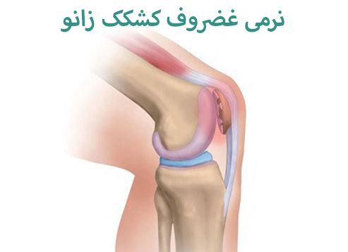چگونه ورزشکاران حرفه‌ای با نرمی غضروف زانو کنار می‌آیند؟