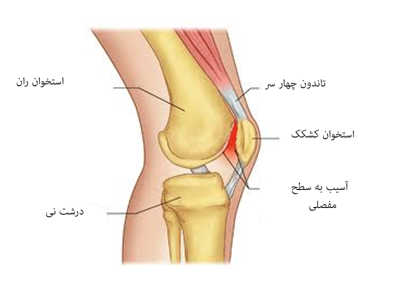 روش های درمان شکستگی کشکک در فیزیوتراپی پونک زنجان