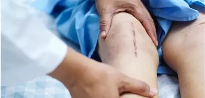 شکستگی کشکک