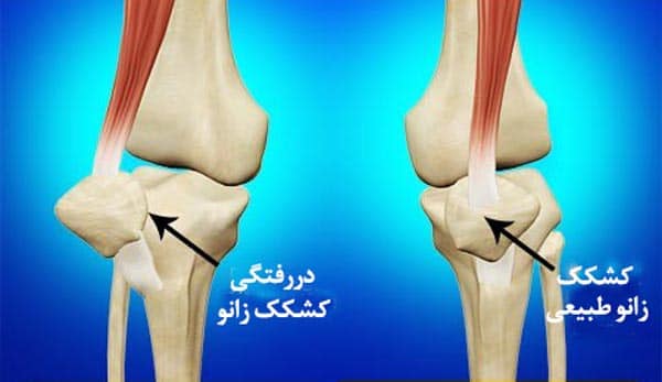 دررفتگی کشکک