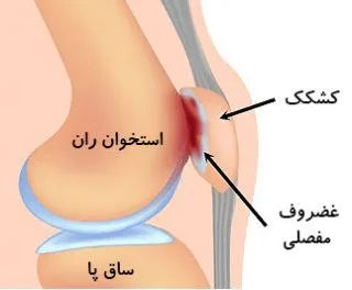 روش های درمان سندروم پاتلوفمورال در فیزیوتراپی پونک زنجان